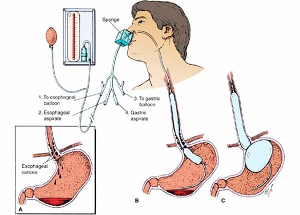 Quy trình đặt ống thông dạ dày: Hướng dẫn chi tiết và những lưu ý quan trọng