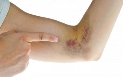 Những phương pháp giảm đau do tụ máu dưới da