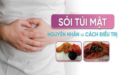 Nguyên nhân triệu chứng và cách điều trị bệnh sỏi mật