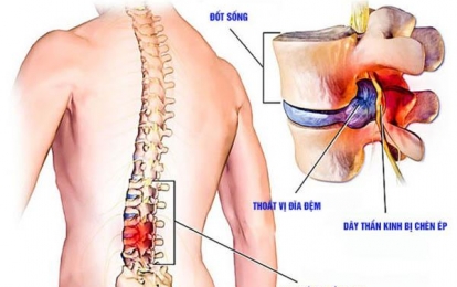 Nguyên nhân và triệu chứng thoát vị đĩa đệm cột sống thắt lưng