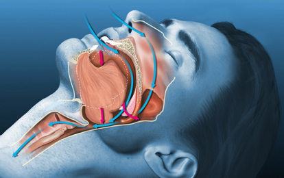 Nguy cơ tiềm ẩn và các giải pháp điều trị hội chứng ngưng thở khi ngủ