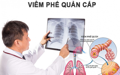 Viêm phế quản cấp là gì và các dấu hiệu nhận biết sớm