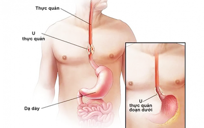 Dấu hiệu quan trọng giúp nhận biết sớm ung thư thực quản