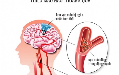 Thiếu máu não thoáng qua và dấu hiệu cảnh báo đột quỵ không thể bỏ qua