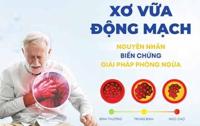 Biến chứng xơ vữa mạch vành và cách phòng ngừa hiệu quả