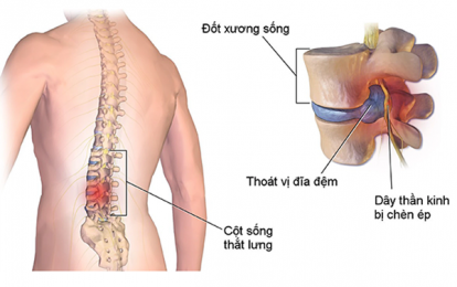 Dấu hiệu thoát vị đĩa đệm thắt lưng bạn tuyệt đối không nên bỏ qua