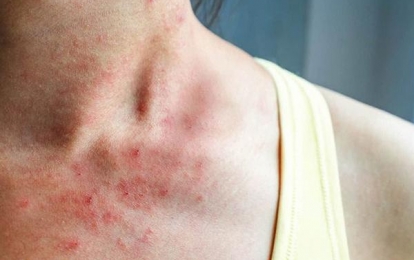 Các biện pháp trị bệnh da liễu thường gặp mùa mưa lũ