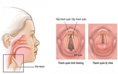 Cao đẳng Dược Sài Gòn chia sẻ về bệnh viêm thanh quản và các cách phòng tránh