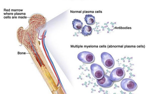 Những điều cần lưu ý về bệnh đa u tủy xương