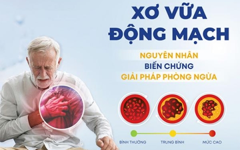 Nguyên nhân và phương pháp chẩn đoán xơ vữa động mạch