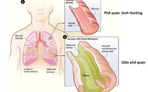 Nguyên nhân và phương pháp chẩn đoán điều trị bệnh giãn phế quản