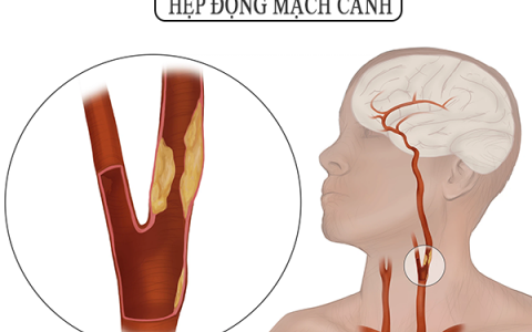 Những điều cần lưu ý về bệnh hẹp động mạch cảnh