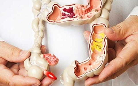Triệu chứng và cách chẩn đoán polyp đại tràng ác tính