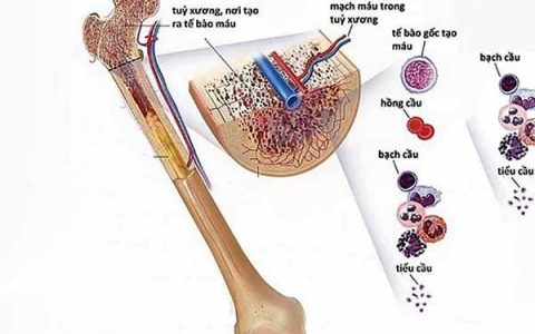 Tiên lượng và hướng điều trị bệnh suy tủy xương cần lưu ý