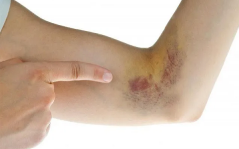 Những dấu hiệu ung thư máu không thể bỏ qua