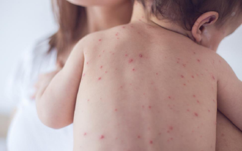 Nhận diện ban sởi ở trẻ em và hướng dẫn chăm sóc đúng cách