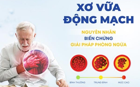 Biến chứng xơ vữa mạch vành và cách phòng ngừa hiệu quả