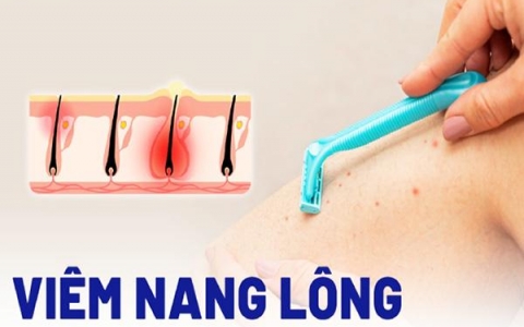 Nguyên nhân và giải pháp điều trị viêm nang lông hiệu quả