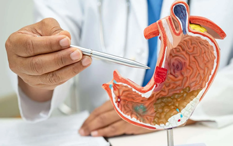 GIST dạ dày và những yếu tố nguy cơ cần lưu ý