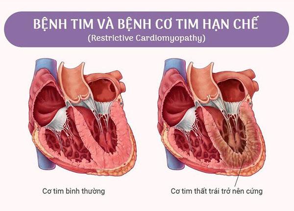 Nguyên nhân và triệu chứng bệnh cơ tim hạn chế