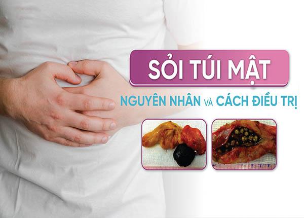 Nguyên nhân triệu chứng và cách điều trị bệnh sỏi mật