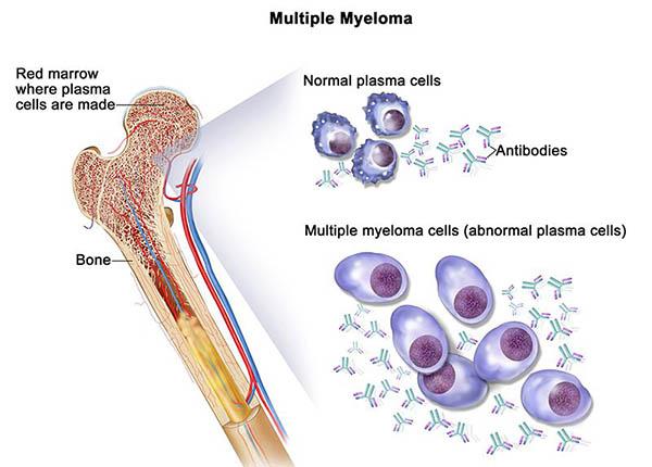 bệnh đa u tủy xương