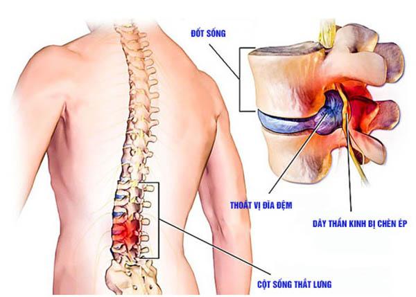 Nguyên nhân và triệu chứng thoát vị đĩa đệm cột sống thắt lưng