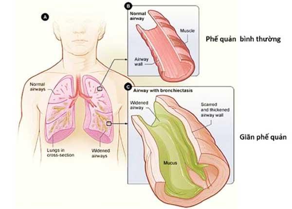 Nguyên nhân và phương pháp chẩn đoán điều trị bệnh giãn phế quản