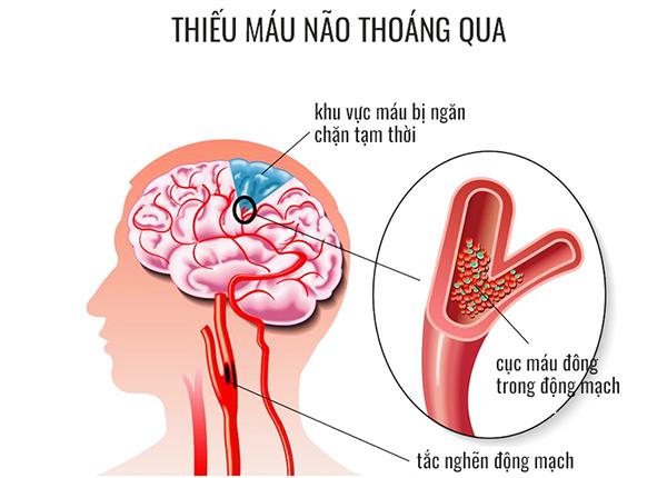 Thiếu máu não thoáng qua và dấu hiệu cảnh báo đột quỵ không thể bỏ qua