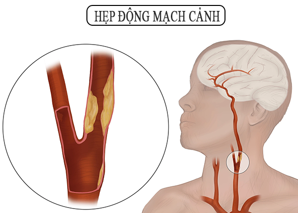 HẸP ĐỘNG MẠCH CẢNH